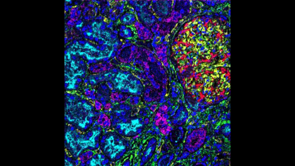 MiBI glomerulus.